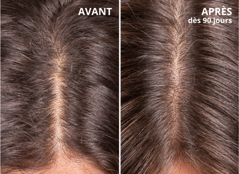 avant après Hair Growth