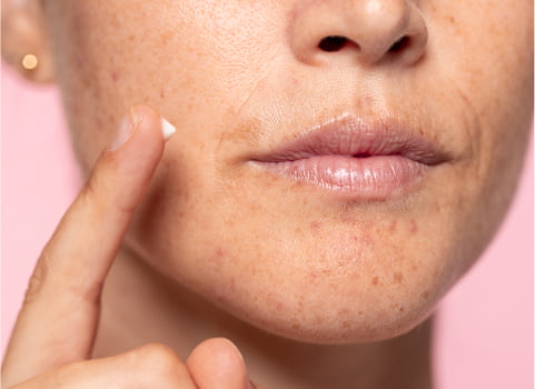types of dark spots on skin photos