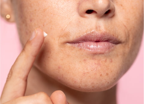 How To Treat Dark Spots According To Dr. Pimple Popper