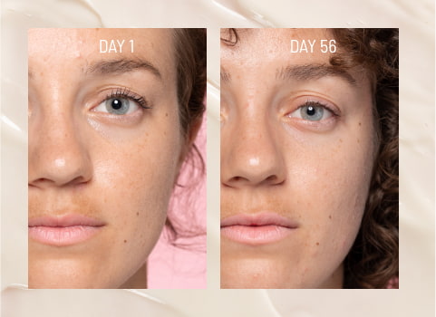 say goodbye to acne scars