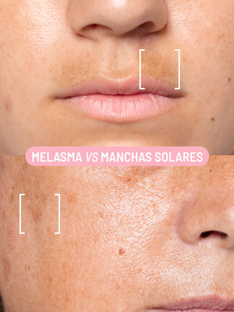 melasma