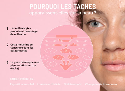 Formation des taches sur la peau