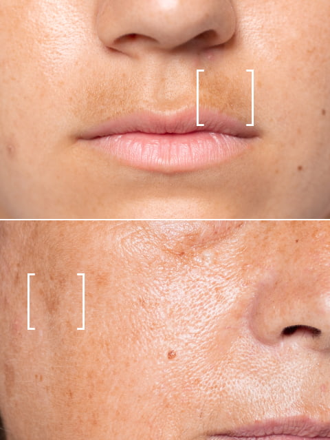 melasma