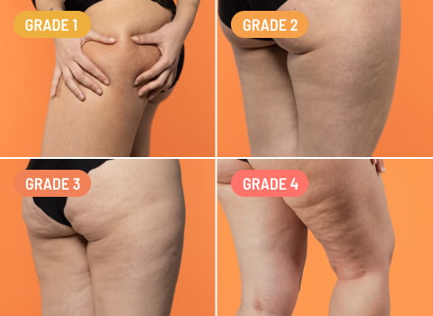 Did you know that there are different types of cellulite? But
