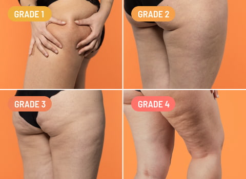 What Causes Cellulite & Where Is It Most Common?