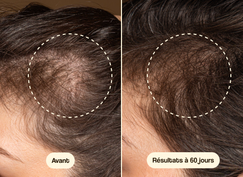 Avant et apr&egrave;s avec Hair Growth & Density Treatment