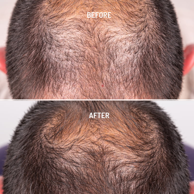 PRP Injections For Hair Loss and PRP Treatments in Northern VA