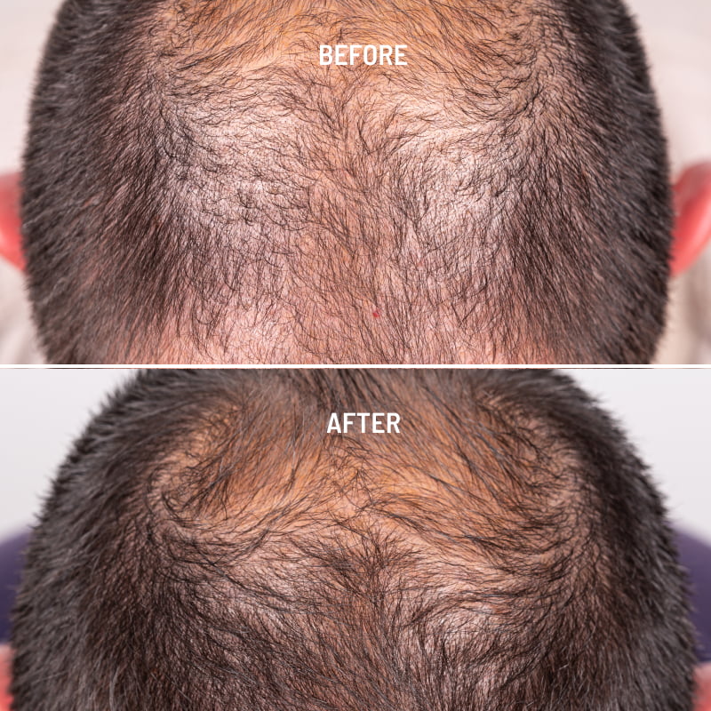 Hair Loss and Thinning  The Latest Treatments