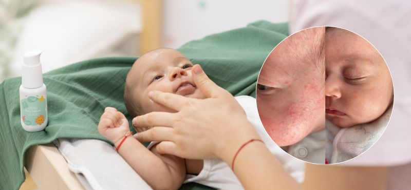 Erupções cutâneas e outros problemas frequentes na pele do rosto dos bebés