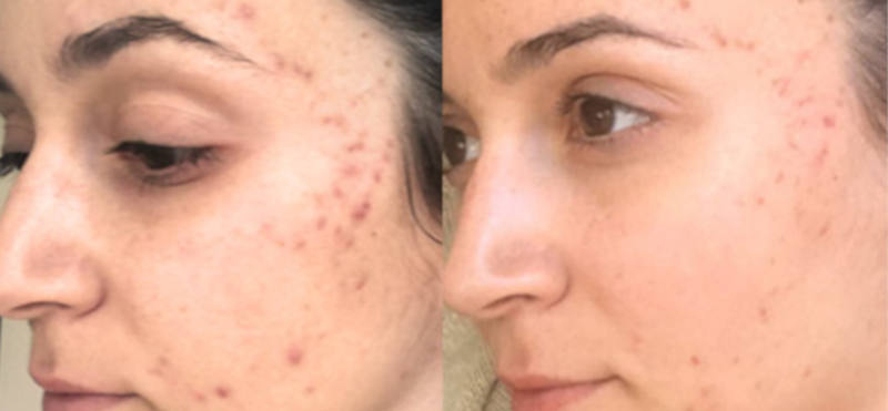 Resultado real: antes y después de utilizar el Shine Control Pack for oily skin de Freshly