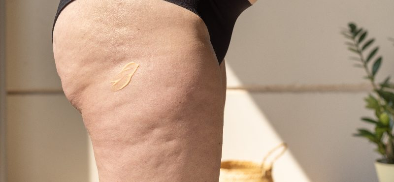 Wussten Sie, dass es verschiedene Arten von Cellulite gibt? Aber... Warum tritt sie auf und wie kann man sie reduzieren? Finde es heraus