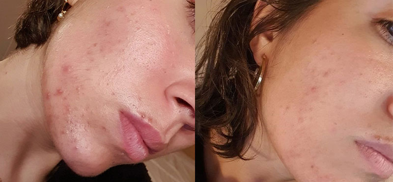 Resultado real: antes y después de utilizar el oil serum y el sérum facial exfoliante enzimático de Freshly Resultado real: antes y después de utilizar el oil serum y el sérum facial exfoliante enzimático de Freshly