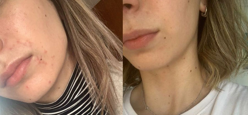 Resultado real: antes y después de utilizar el gel limpiador y el sérum facial exfoliante enzimático de Freshly Resultado real: antes y después de utilizar el gel limpiador y el sérum facial exfoliante enzimático de Freshly